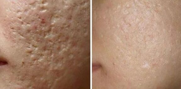 Craquettes laser broyantes