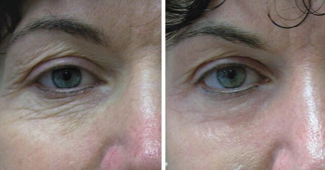 Laser de la peau autour des yeux